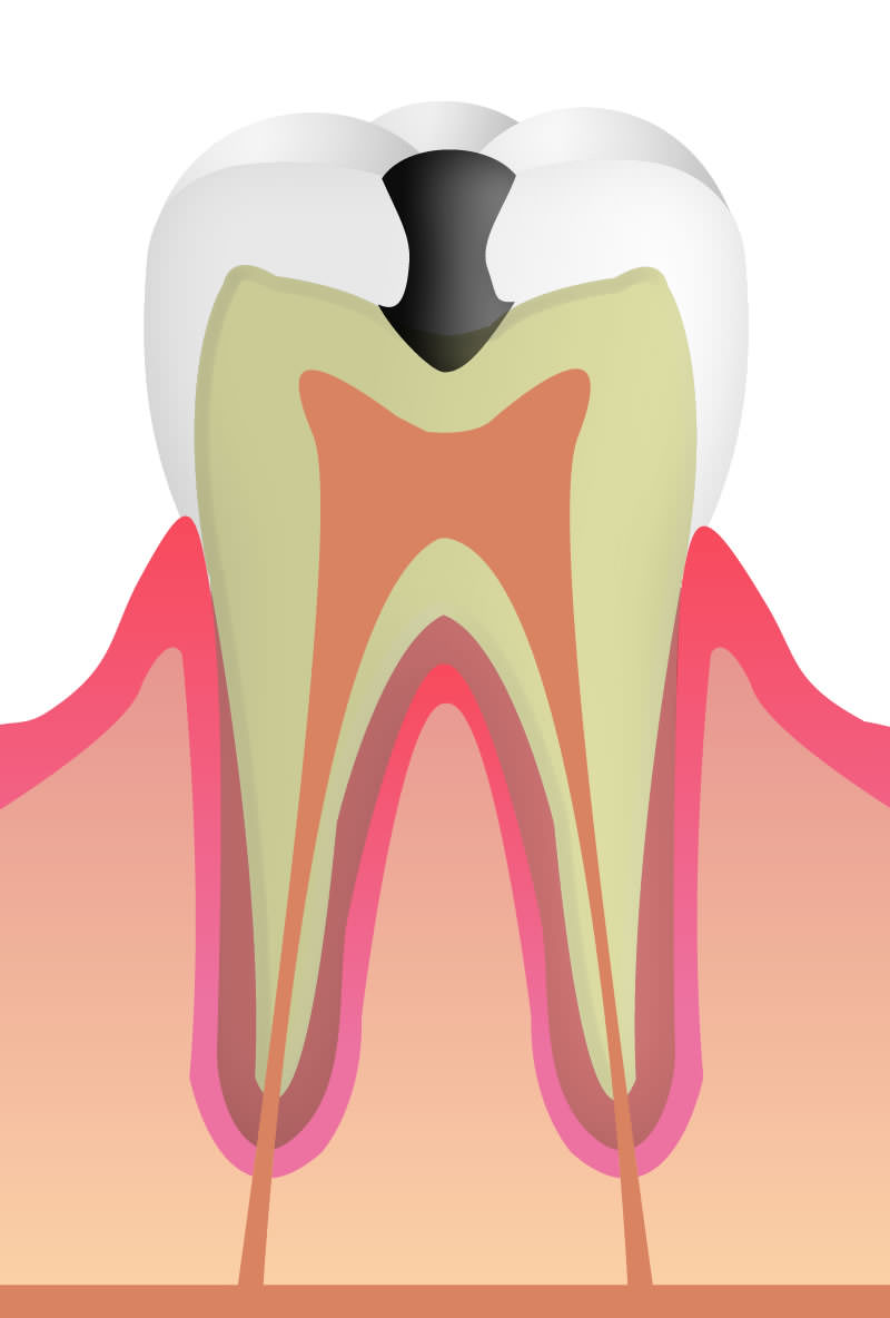 C3：歯の根の虫歯